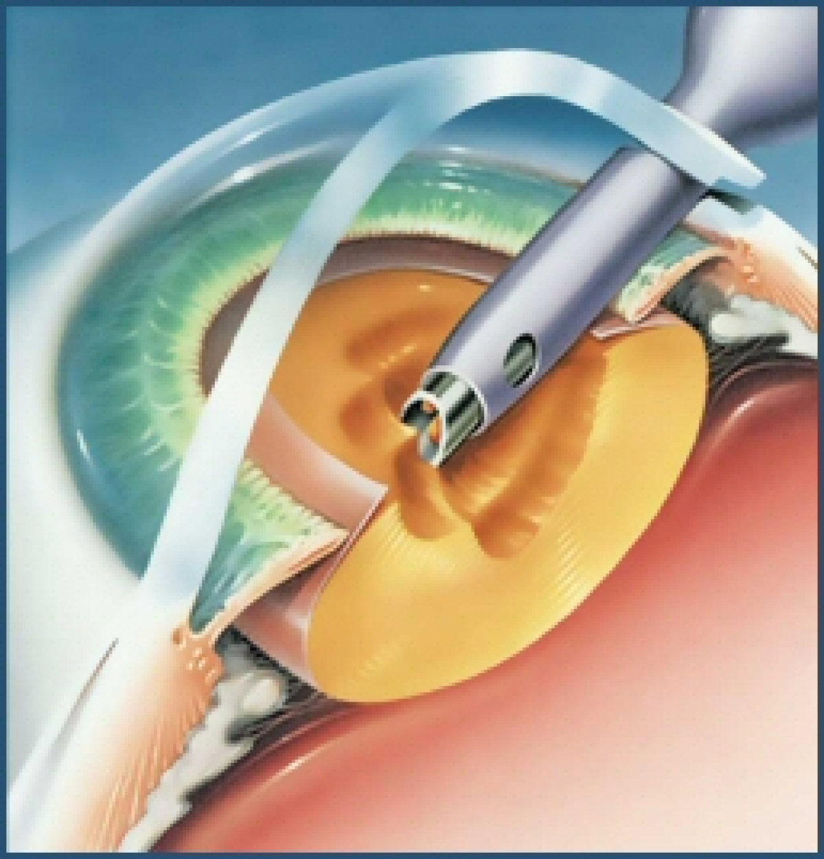 ¿La Cirugía de Catarata es con Láser?