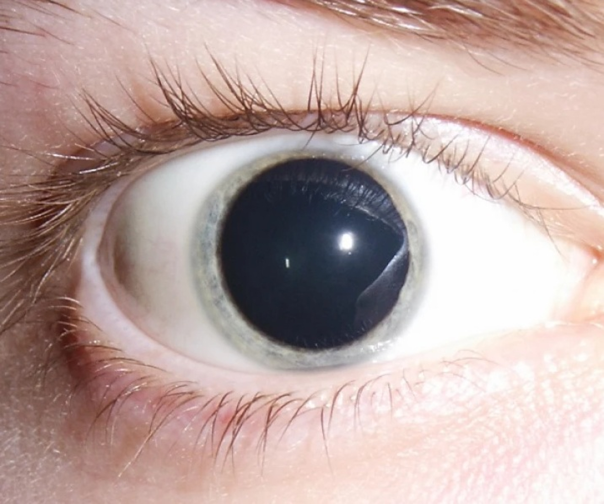 ¿Por qué me dilatan las pupilas en una consulta oftalmológica? 