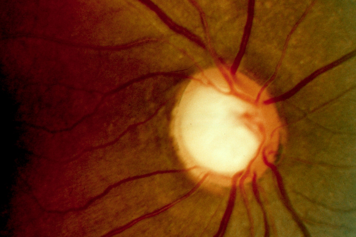 ¿Qué es el Glaucoma?