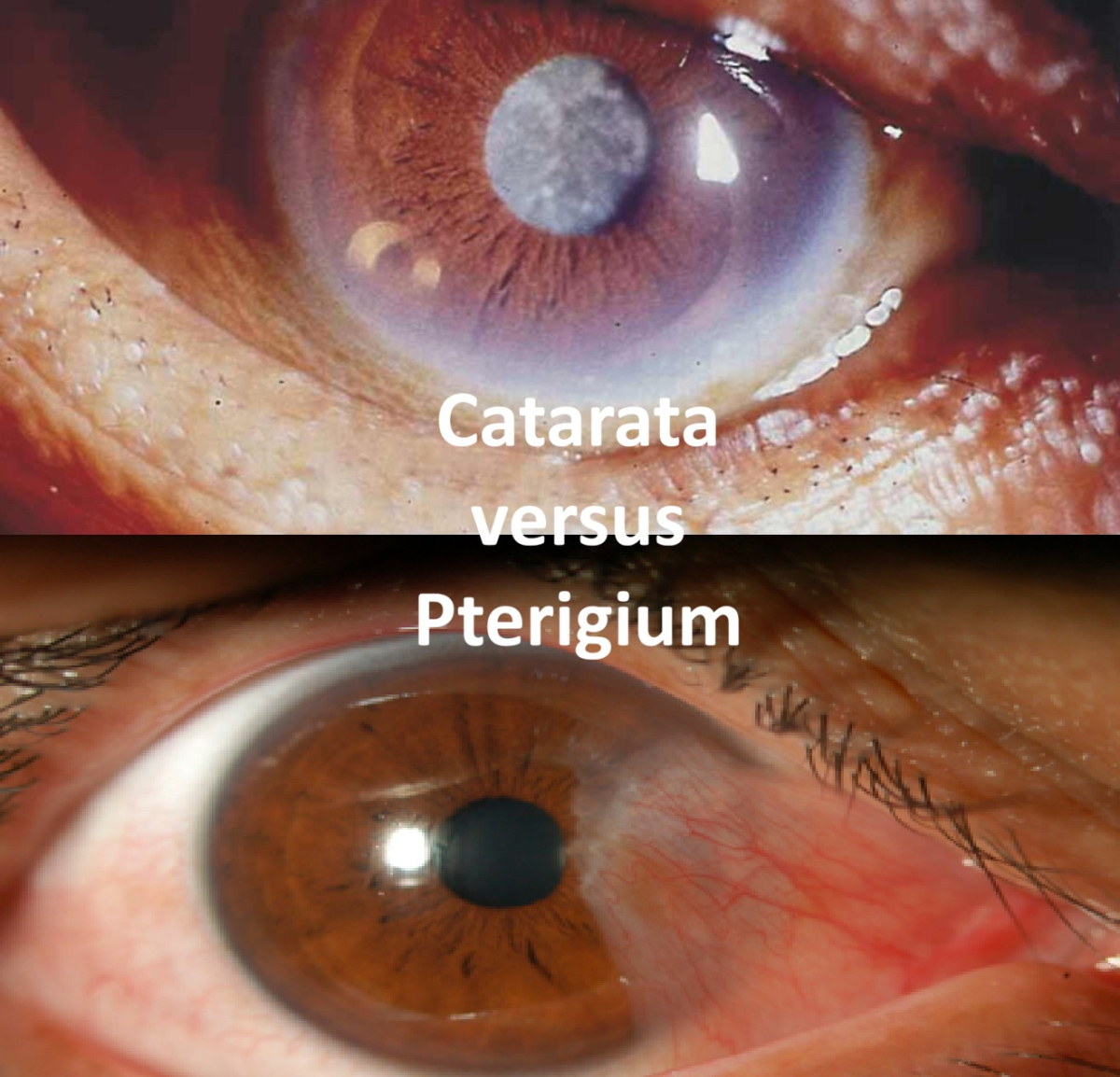¿Tengo catarata o “carnosidad”? ¡NO SON LA MISMA COSA!